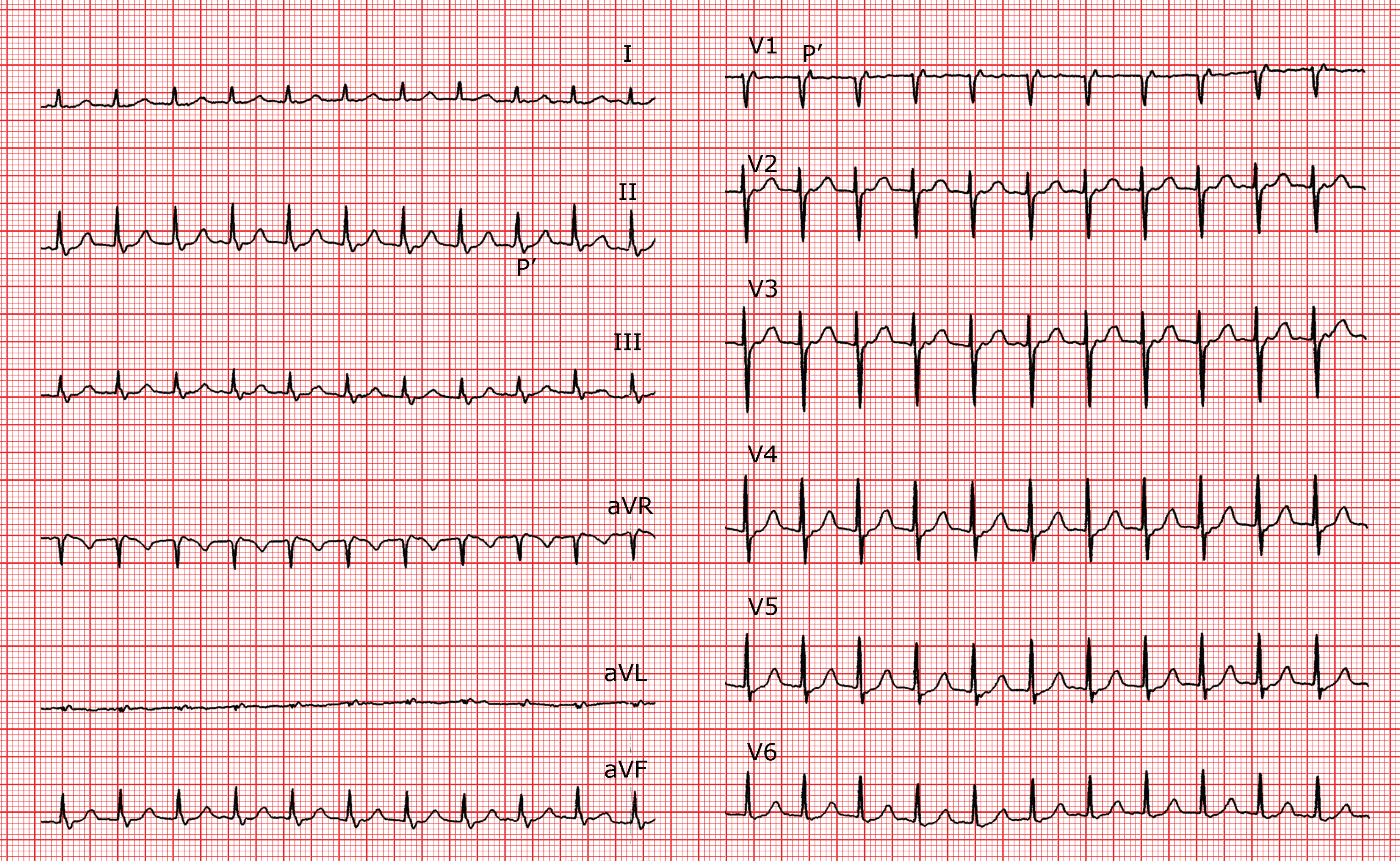 Cardio Fr Die Supraventrikularen Tachykardien