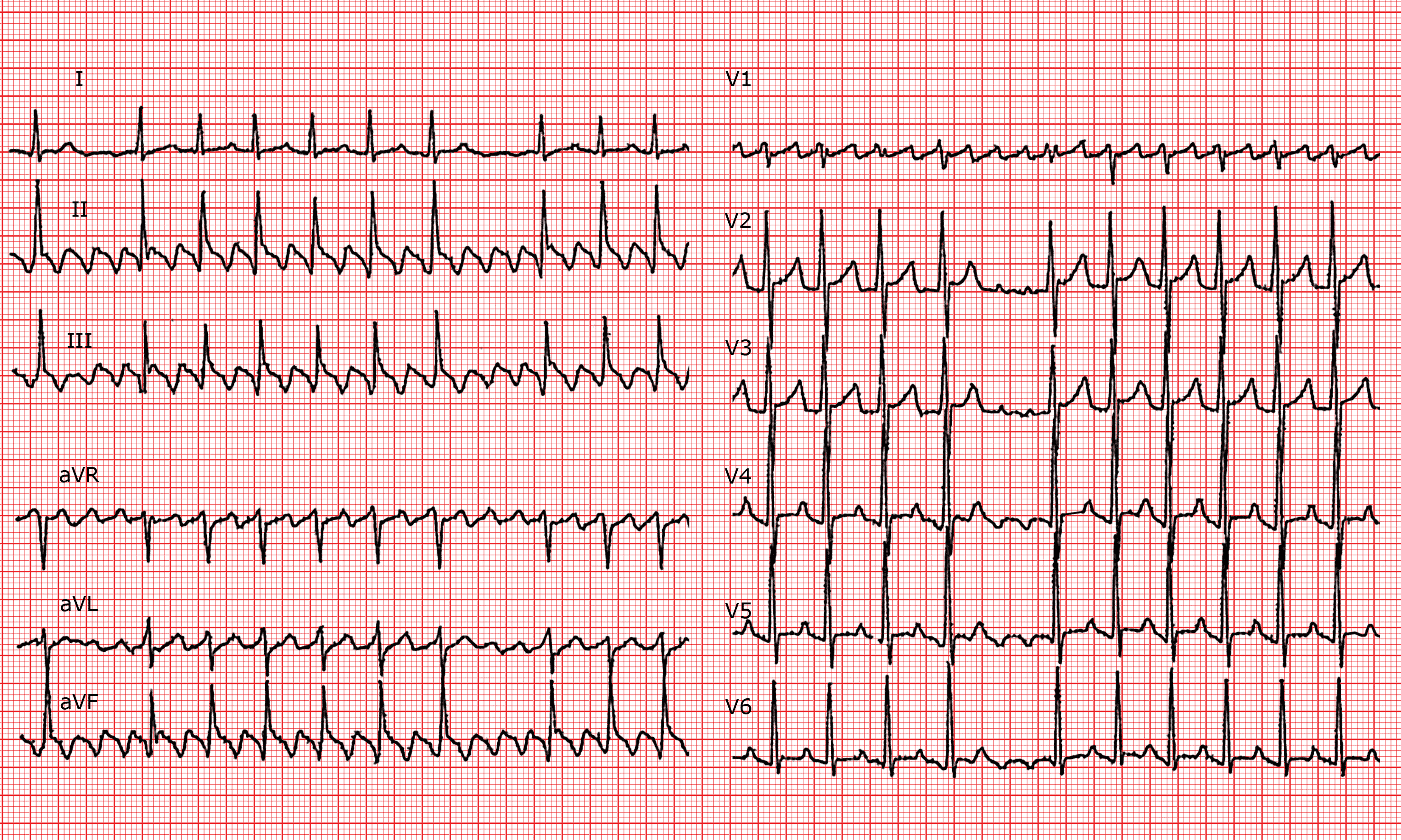 Ecg Basics Atrial Flutter With Conduction Ratio Rhythm Strip Sexiz Pix ...