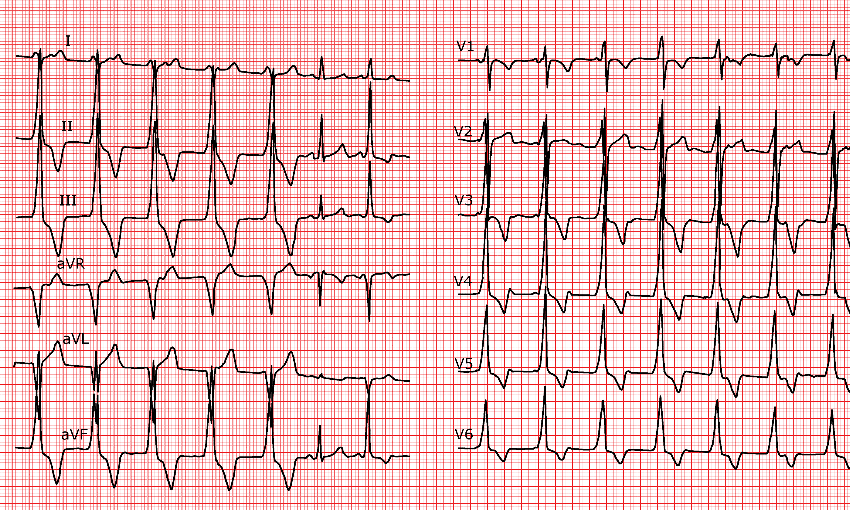  Cardio FR Accelerated Idioventricular Rhythm AIVR A V Dissociation 