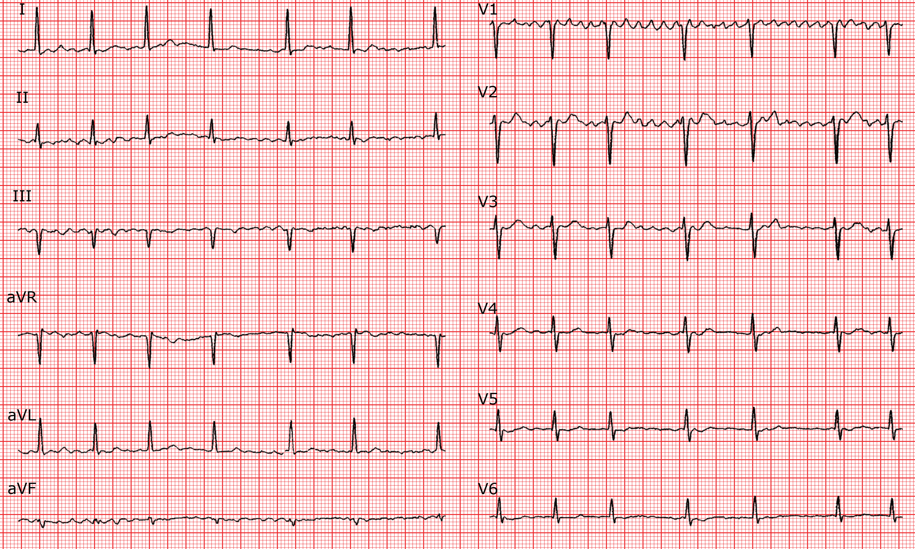 Atrial Fibrillation Ecg